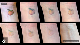 Removery Tattoo Removal & Fading photo 7