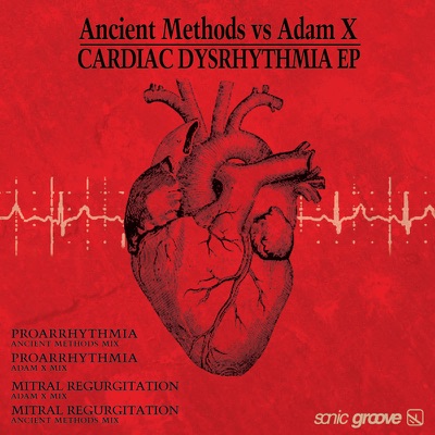 Cardiac Dysrhythmia - EP