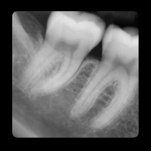 Teeth - Single