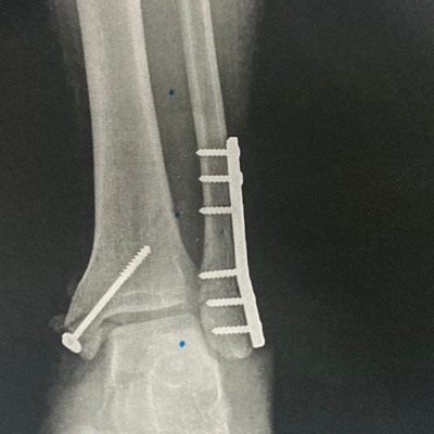 Quebrei Meu Pé - Single