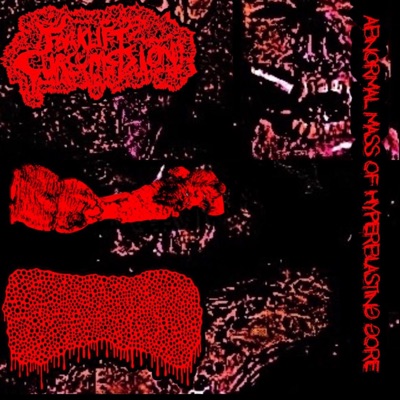 ABNORMAL MASS OF HYPERBLASTING GORE (3 Way split w Lymphoedema and MYCOSIS)