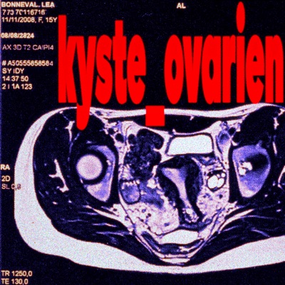 kyste_ovarien