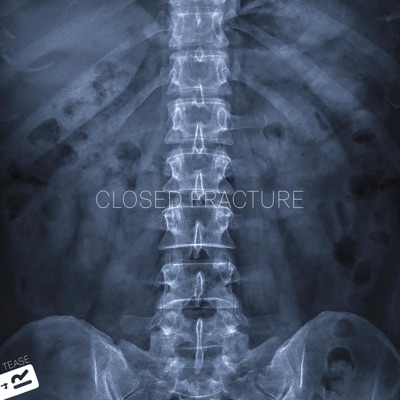 Closed Fracture - Single