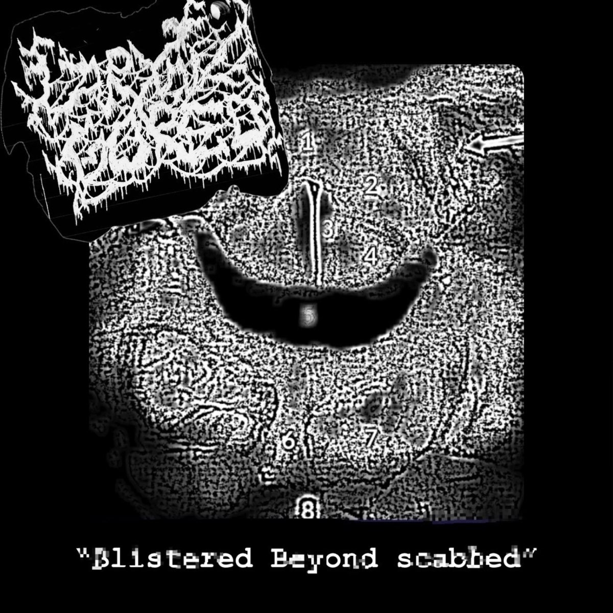 ‎Blistered beyond scabbed - Single - Album by LarynxGored - Apple Music