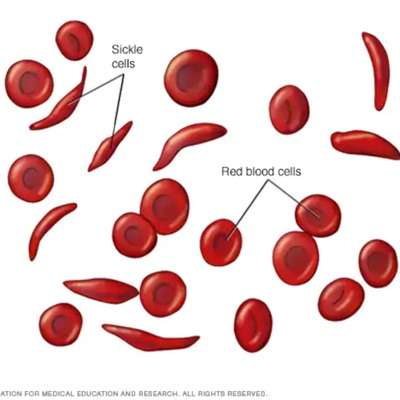 SICKLE CELL SAVIOR (feat. Plop) - Single