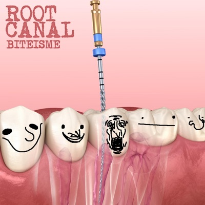 Root Canal - Single
