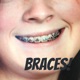 Braces!