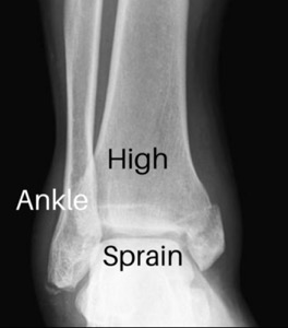 High Ankle Sprain