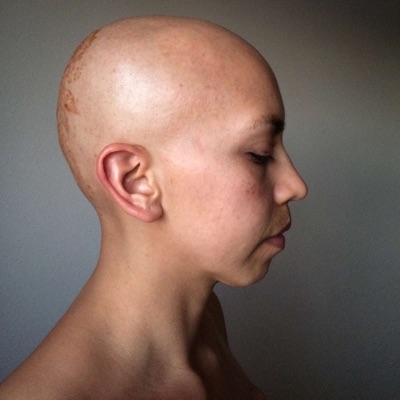 The Bald Project