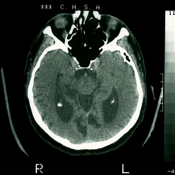 Battling brain rot