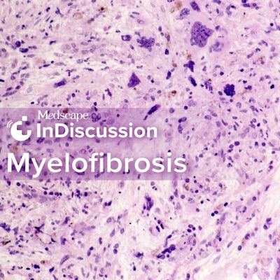 Medscape InDiscussion: Myelofibrosis Medscape InDiscussion: Myelofibrosis