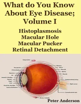 Read: What Do You Know About Book Eye Disease; Volume I: Histoplasmosis, Macular Hole, Macular Pucker and Retinal Detachment