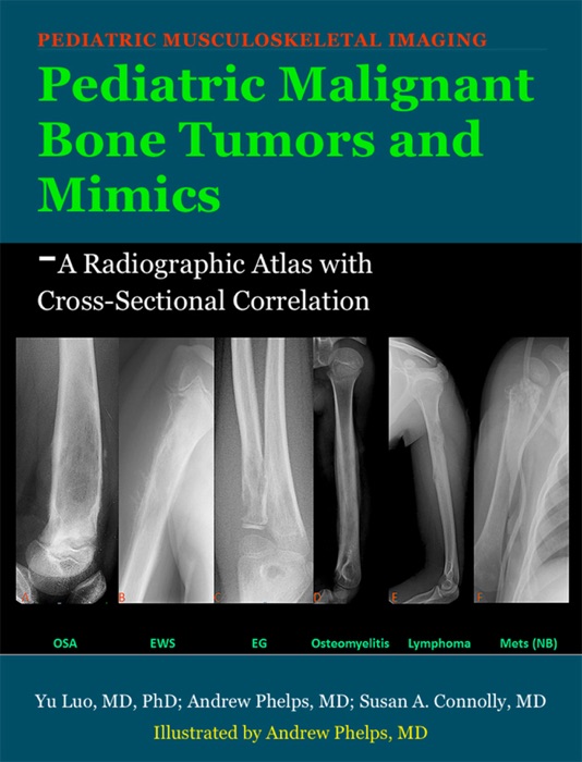 Pediatric Malignant Bone Tumors and Mimics