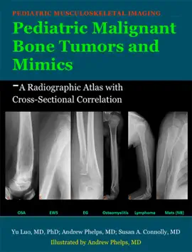 Read: Pediatric Malignant Bone Tumors Book and Mimics