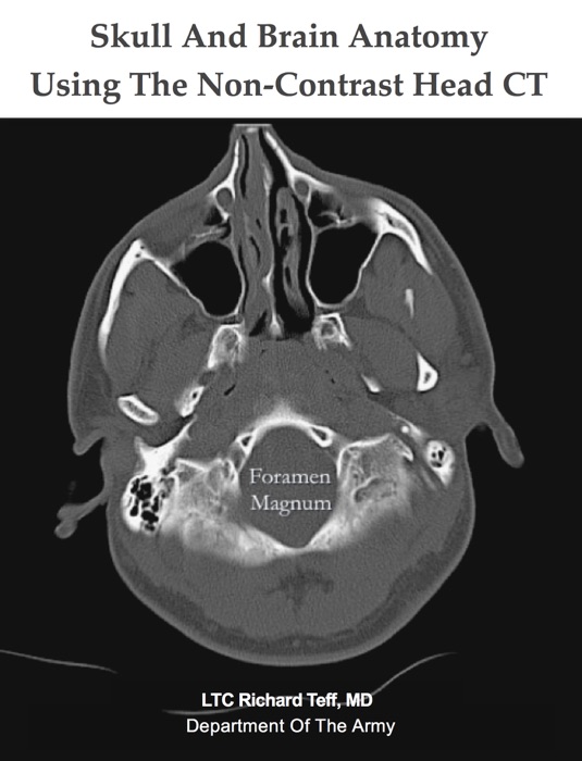 Skull And Brain Anatomy Using The Non-Contrast Head CT