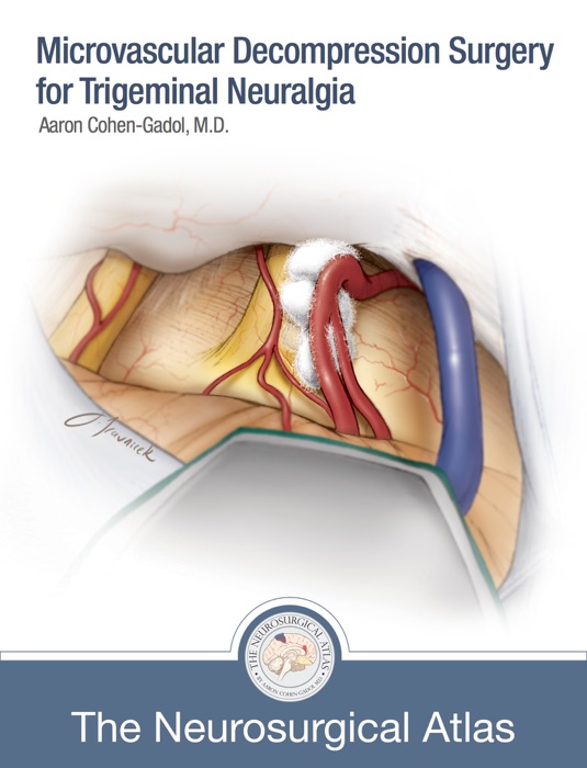 Microvascular Decompression Surgery for Trigeminal Neuralgia