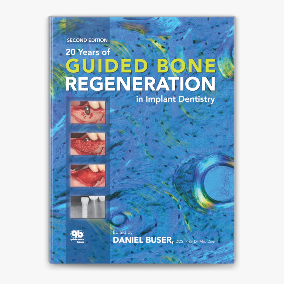 20 Years of Guided Bone Regeneration in Implant Dentistry by 