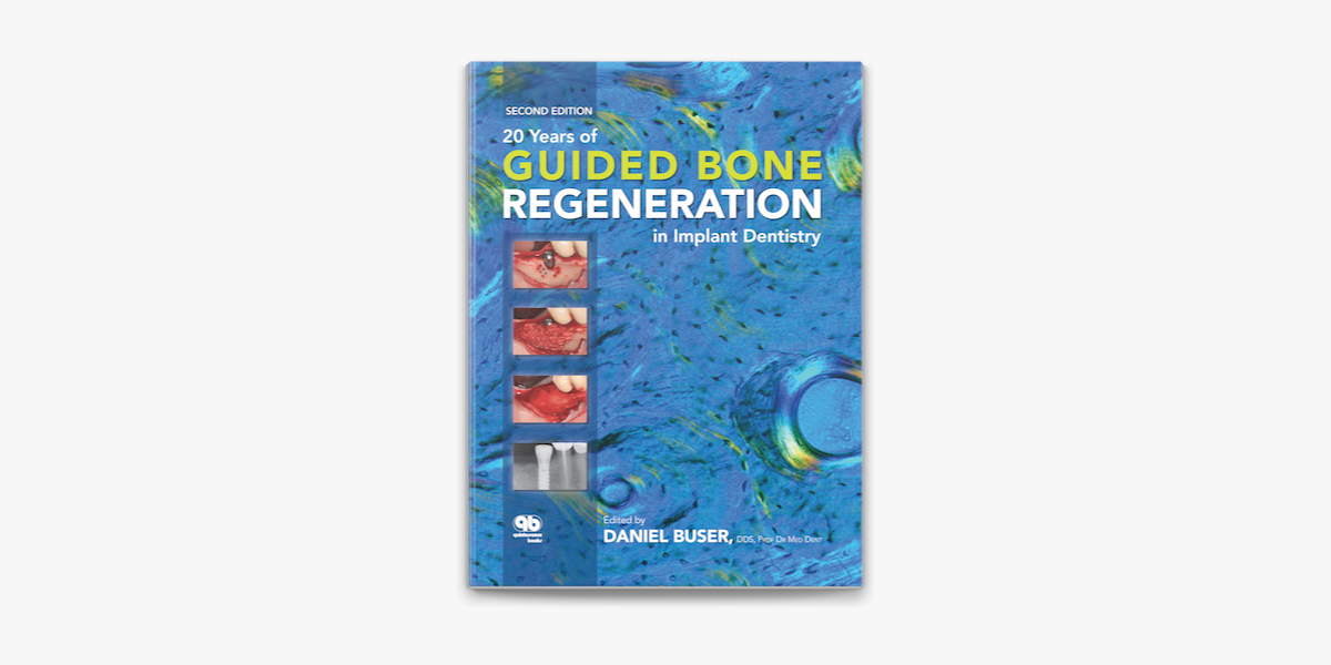 20 Years of Guided Bone Regeneration in Implant Dentistry by 