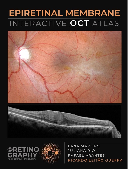 EPIRETINAL MEMBRANE - INTERACTIVE OCT ATLAS