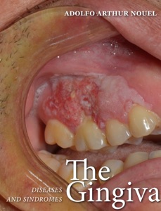The Gingiva. Diseases and Syndromes