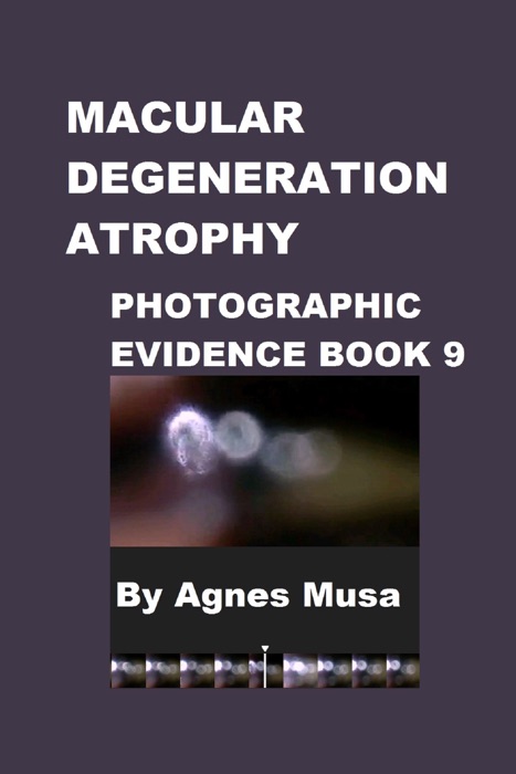 Macular Degeneration Atrophy, Photographic Evidence Book 9