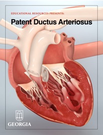 Patent Ductus Arteriosus - Educational Resources, University of Georgia