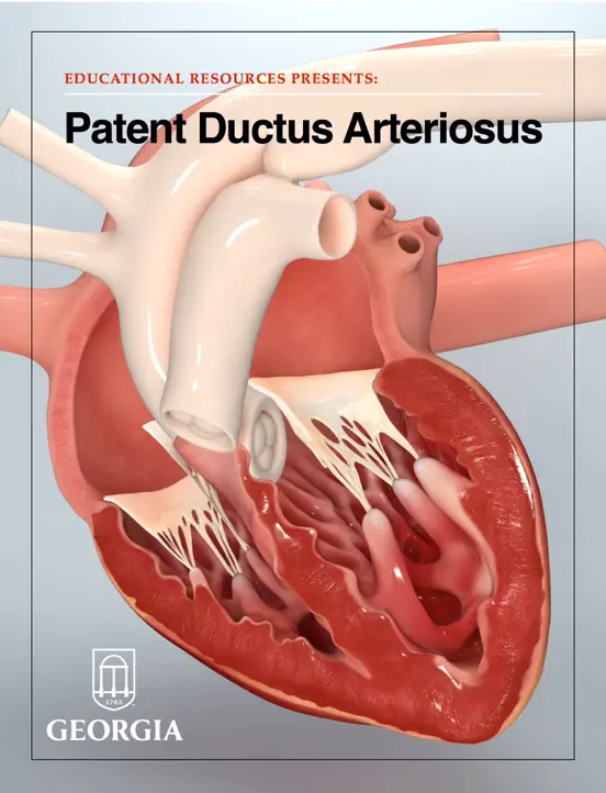 Patent Ductus Arteriosus