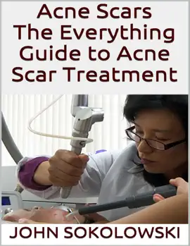 Read: Acne Scars: The Everything Book Guide to Acne Scar Treatment