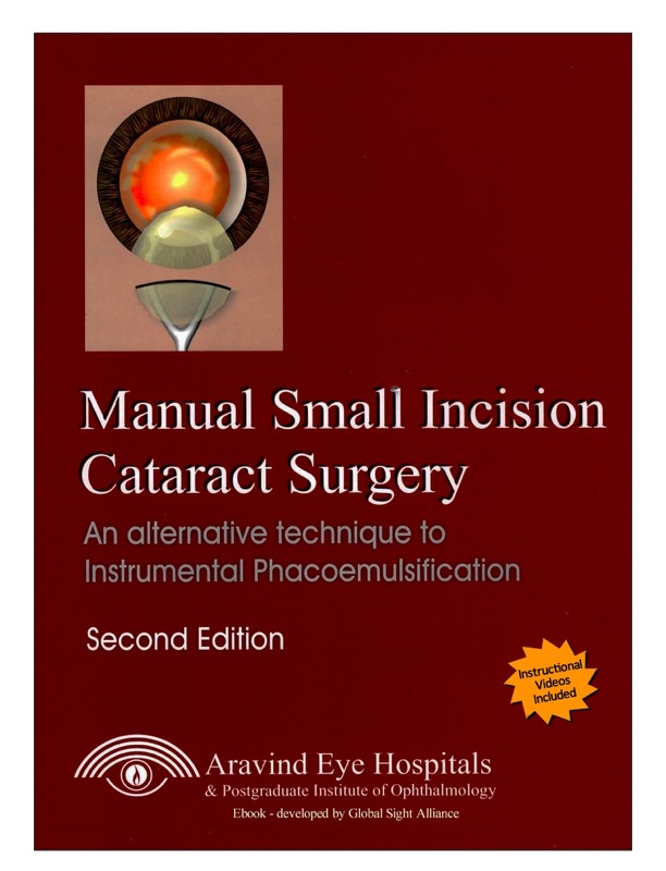 Manual Small Incision Cataract Surgery