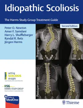 Read: Book Idiopathic Scoliosis
