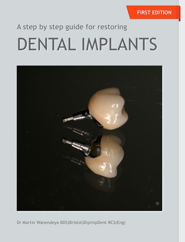 A Step By Step Guide to Restoring Dental Implants