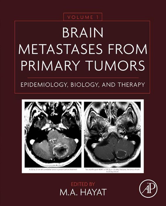 Brain Metastases from Primary Tumors
