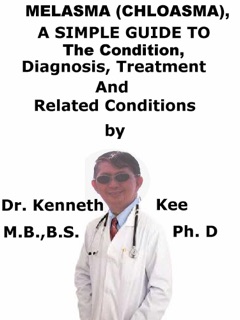Melasma, (Chloasma) A Simple Guide To The Condition, Diagnosis, Treatment And Related Conditions by Kenneth Kee