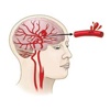 Stroke and Hemorrhage