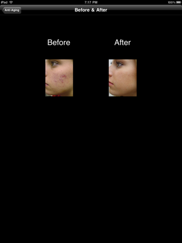 Screenshot #6 pour Acne Clear