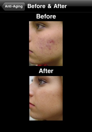 Acne Clear screenshot-3