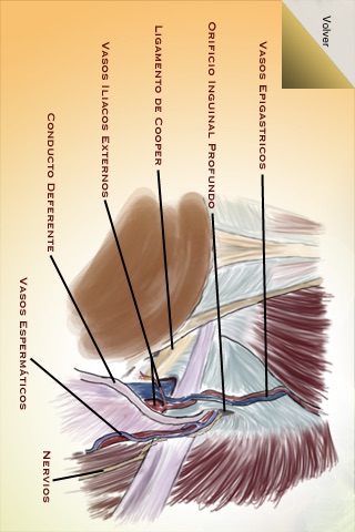Hernia Inguinal -- Cirugía Laparoscópica de la Hernia Inguinal Lite