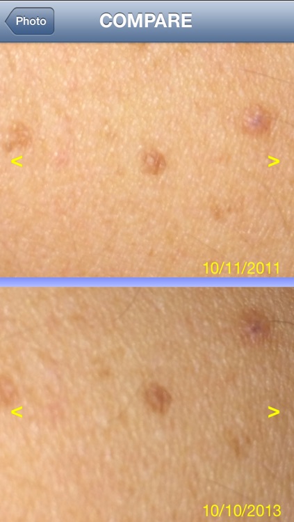 Skin Prevention – Photo Body Map for Melanoma and Skin Cancer early detection screenshot-3