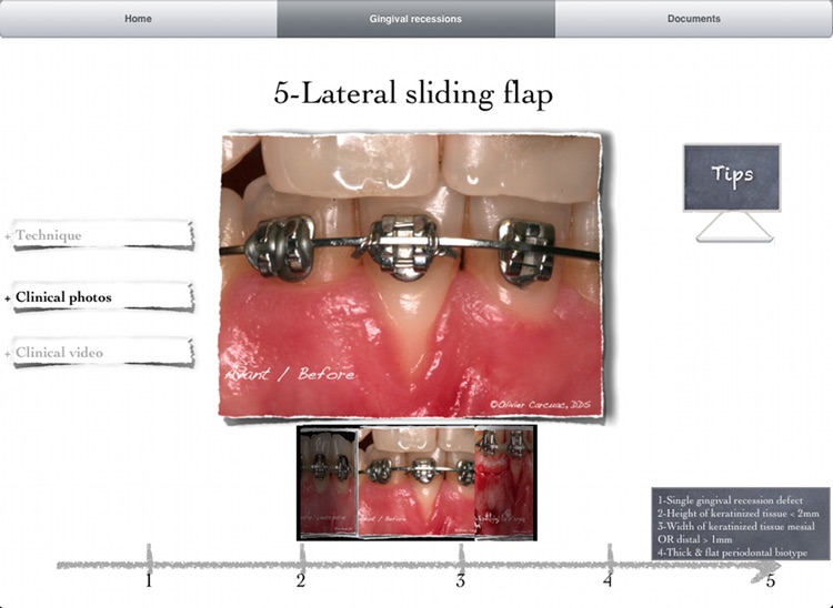 iMuco Gingival recessions