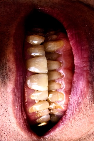 Aggravate Grind Teeth