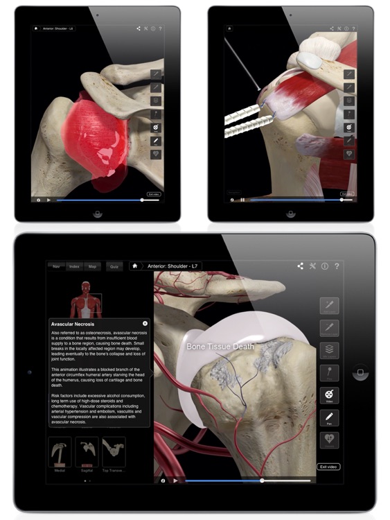 Shoulder Pro III for iPad
