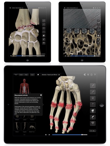 Hand & Wrist Pro III for iPad screenshot 3