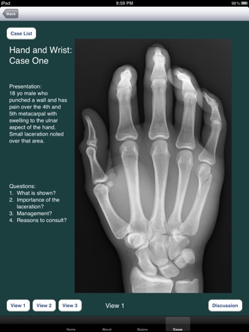 FracturED: A Fracture in the ED; Module 1: Hand and Wrist screenshot 3