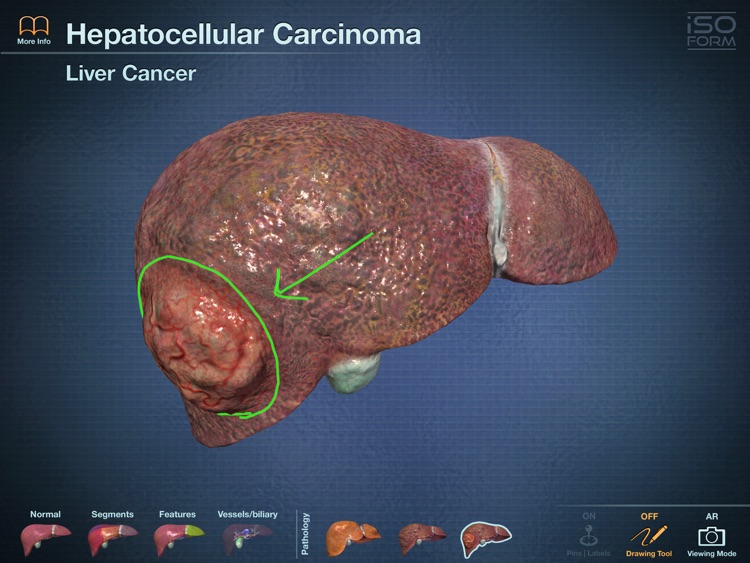 AR Liver Viewer screenshot-4