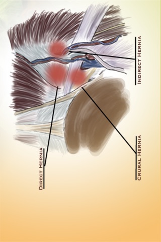 Laparoscopic Inguinal Hernia Repair screenshot 2