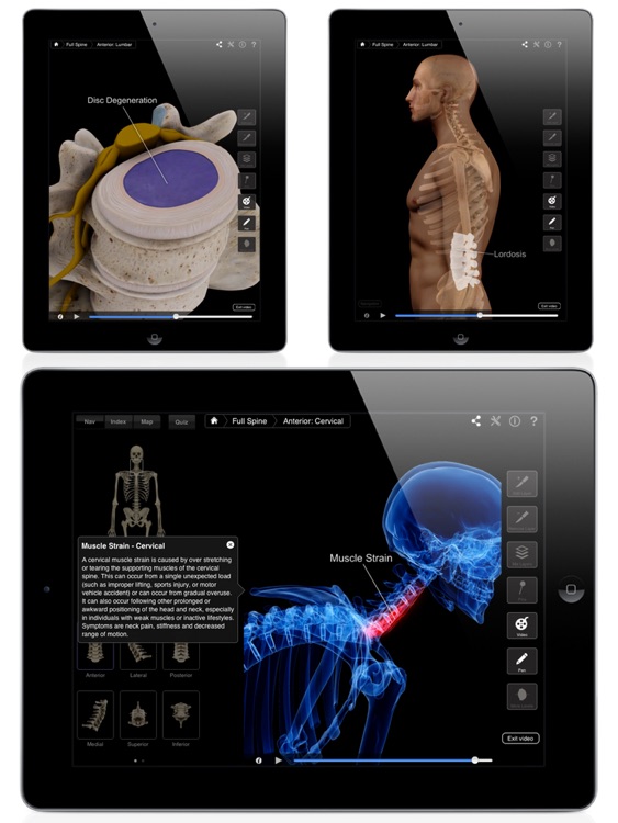 Spine Pro III