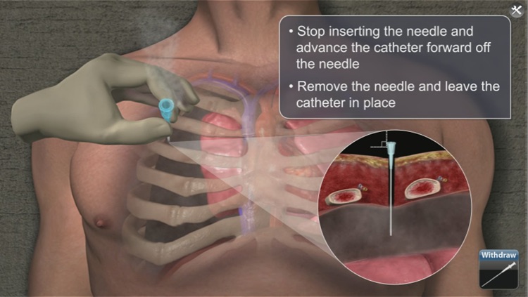 Medrills: NCD for Pneumothorax