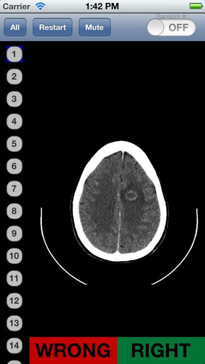 Neuroradiology Flashcards