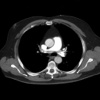 Chest Radiology Flashcards