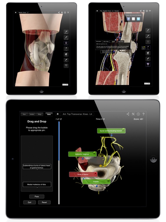 Knee Pro III for iPad screenshot-4